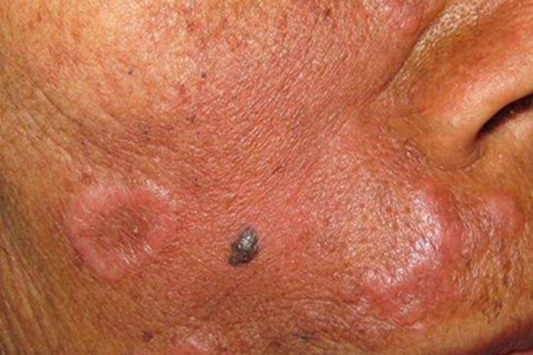 局限型环状肉芽肿症状图 局限型环状肉芽肿症状图