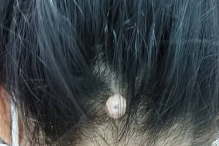 皮肤纤维瘤头皮圆疙瘩图 皮肤纤维瘤头皮圆疙瘩图