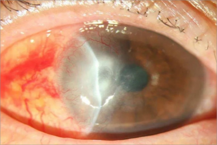 暴露性角膜炎眼部症状图