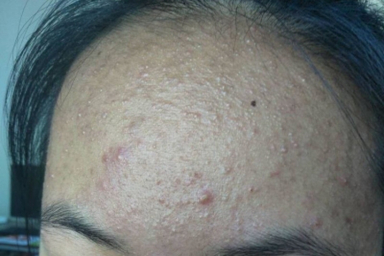 热带痤疮前额长疙瘩图