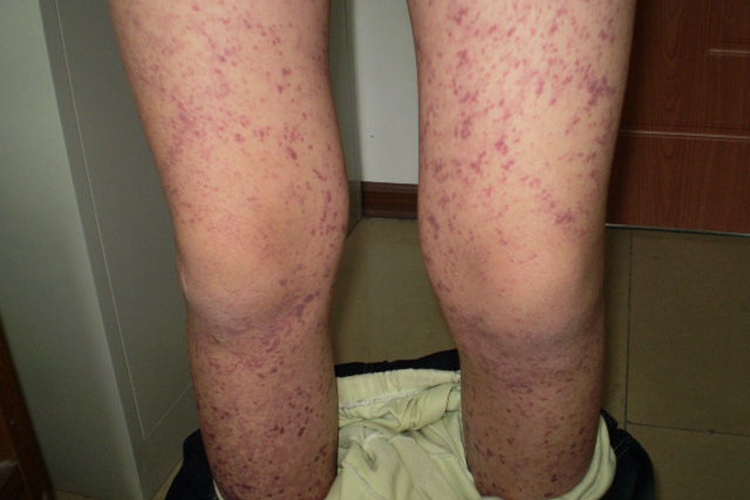 单纯性紫癜膝盖症状图