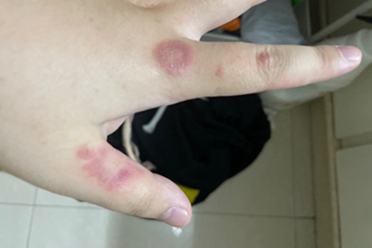 玫瑰糠疹手指红斑图