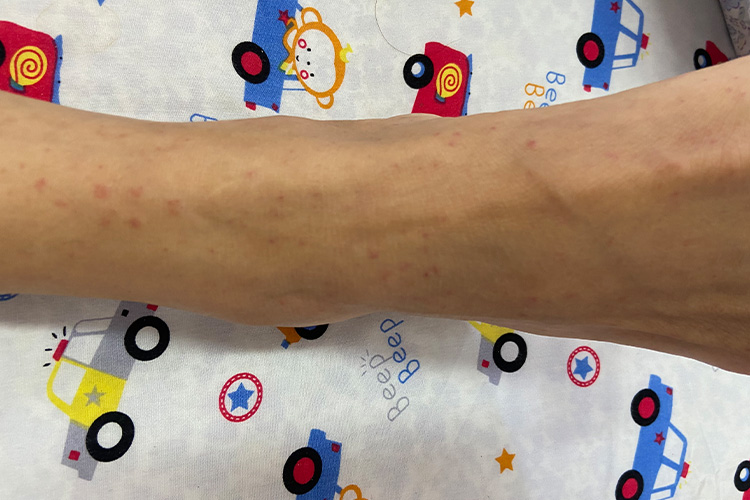 过敏性紫癜小血点图