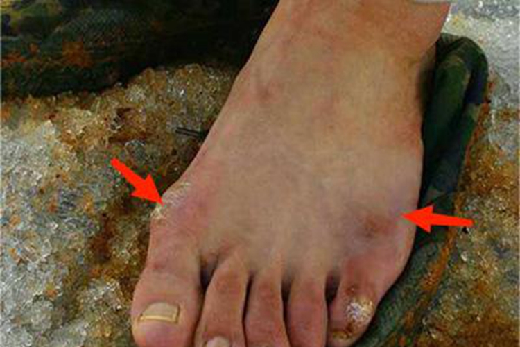 Ⅱ度冻伤脚部红肿图