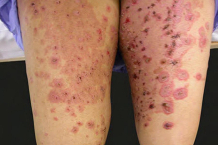 副肿瘤性天疱疮大腿症状图 副肿瘤性天疱疮大腿症状图