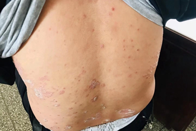 寻常型银屑病背部症状图