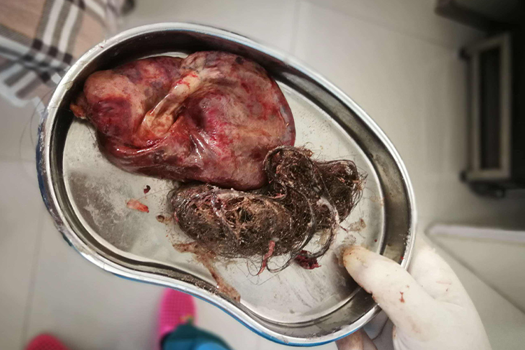 成熟性畸胎瘤图