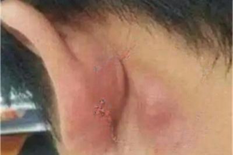 传染性单核细胞增多症耳后症状图 传染性单核细胞增多症耳后症状图