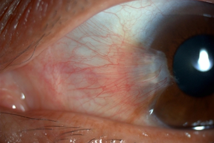 翼状胬肉症状图