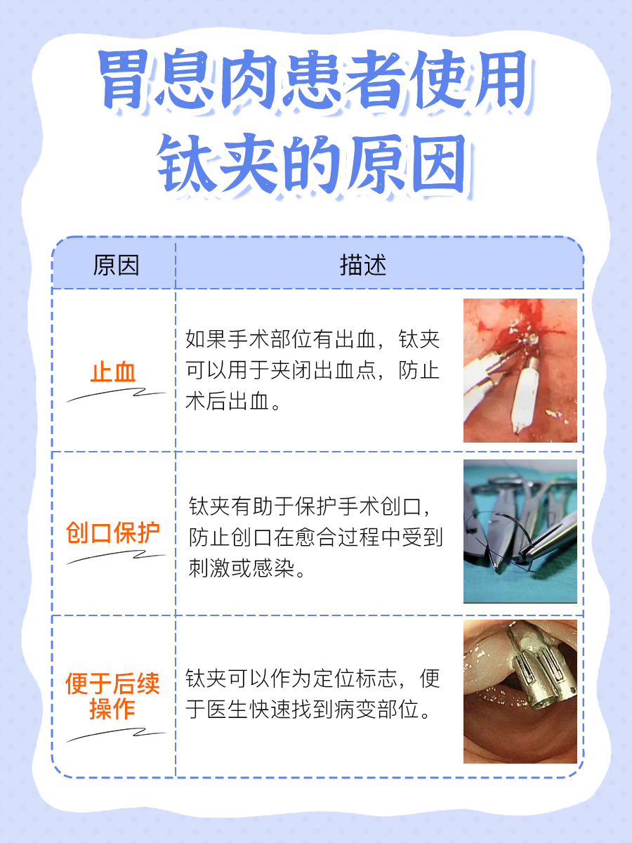 胃息肉钛夹四年没掉,这是怎么回事?