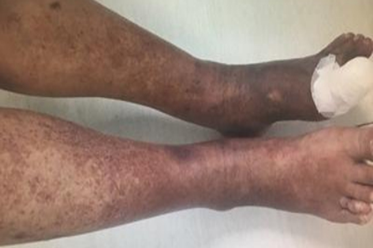 糖尿病性皮肤病小腿皮肤发黑图