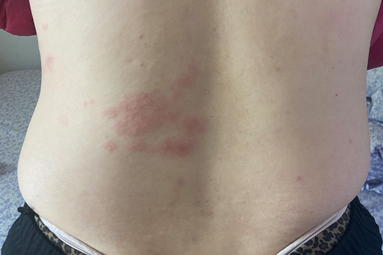 带状疱疹初期丘疹皮损图