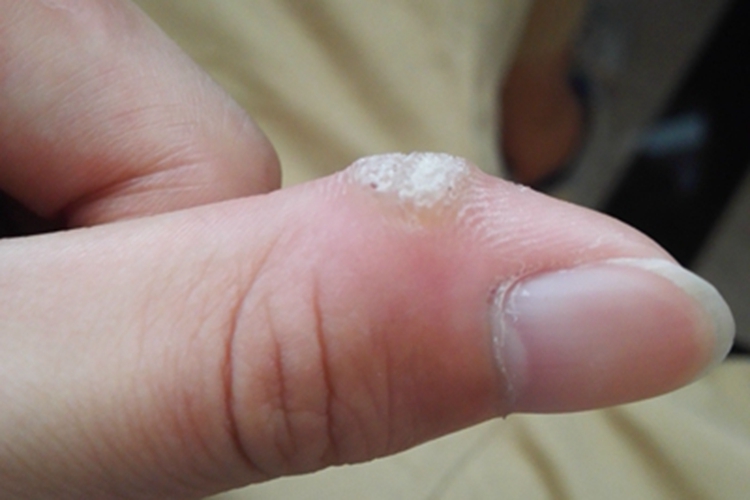 皮肤钙质沉着症手指症状图