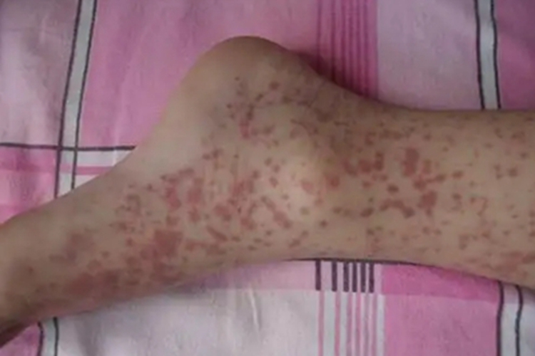 继发性血小板减少性紫癜症状图 继发性血小板减少性紫癜症状图