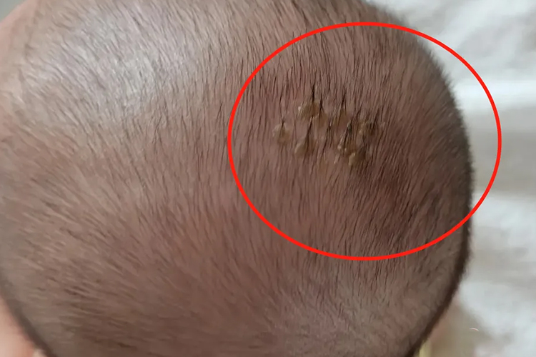 小婴儿头上的结痂图片_有来医生