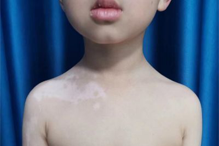 节段型白癜风皮肤发白图 节段型白癜风皮肤发白图