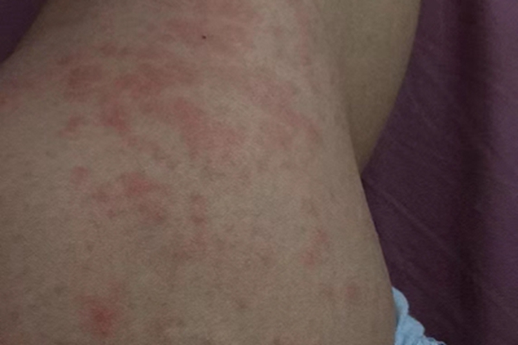 荨麻疹型药疹丘疹图 荨麻疹型药疹丘疹图