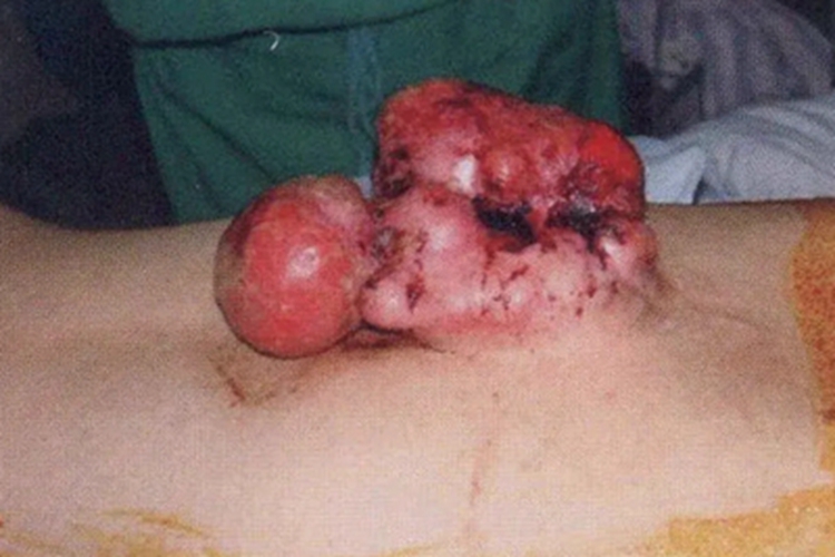 成人型纤维肉瘤背部肿块图