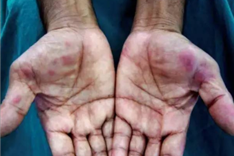 持久性隆起性红斑手掌症状图