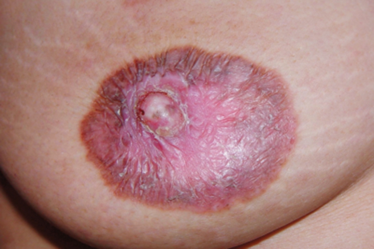 乳房Paget病红斑图