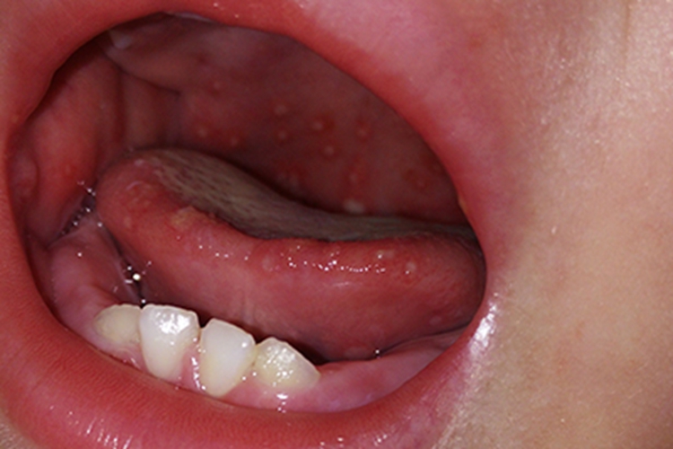 原发性口腔单纯性疱疹小水疱图 原发性口腔单纯性疱疹小水疱图