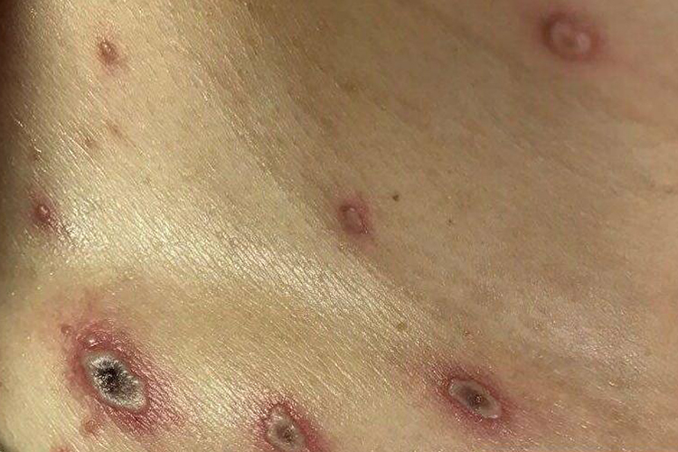 继发感染水痘发白图 继发感染水痘发白图