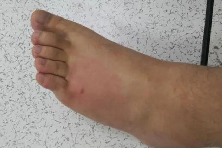 蜈蚣咬后局部肿胀图