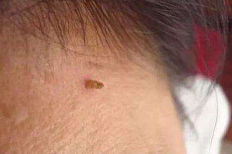 女性脖子棕色丝状疣图