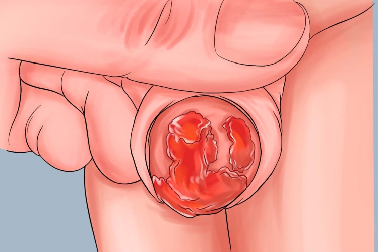 浆细胞性龟头炎龟头糜烂手绘图