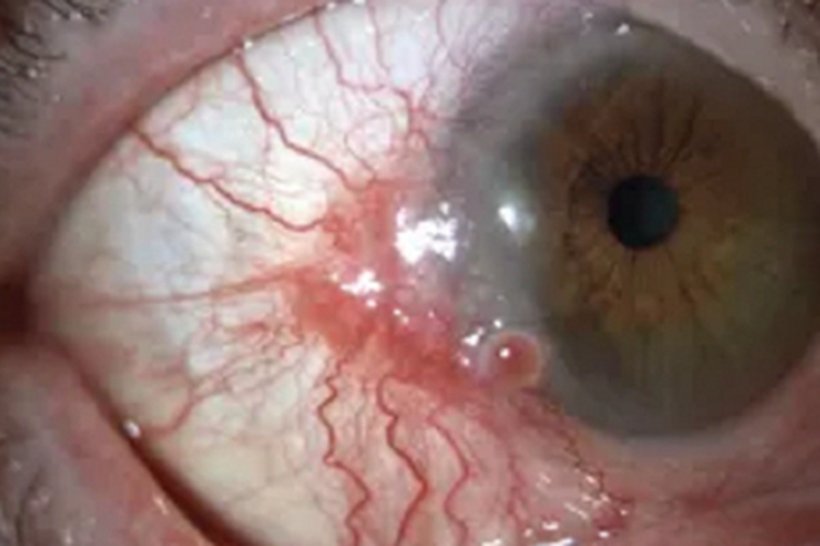 角膜鳞状上皮细胞癌眼球肉粒图