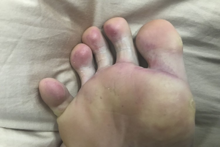 冷凝集素综合征脚趾青紫图 冷凝集素综合征脚趾青紫图