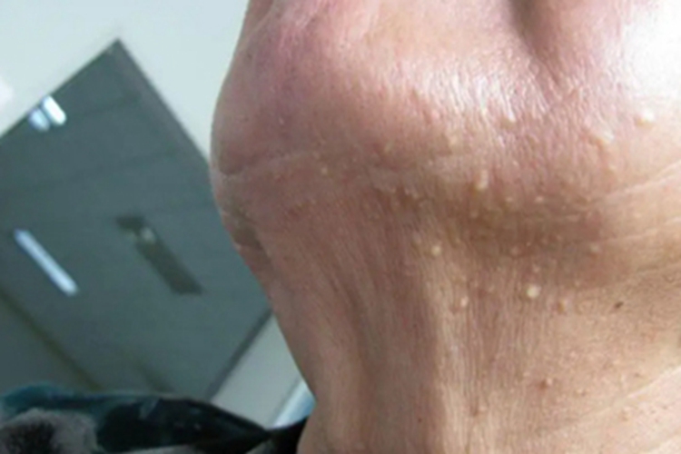 穿通性疾病前颈症状图