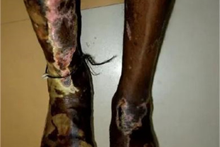 鼠疫皮肤发黑图