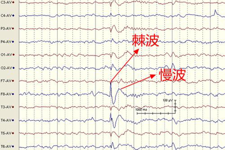 视频脑电图结果显示图
