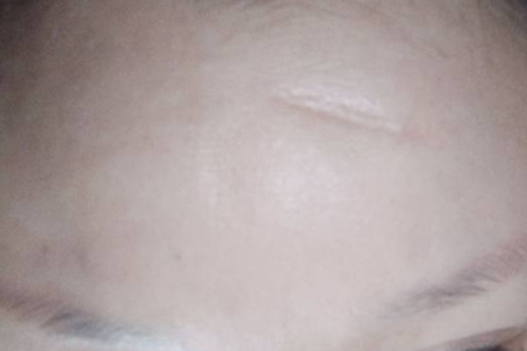 萎缩性瘢痕前额症状图 萎缩性瘢痕前额症状图