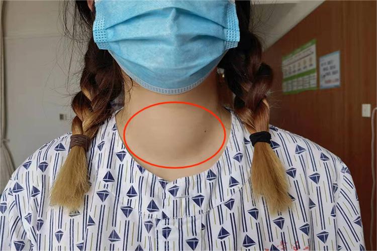 甲状腺癌肿块图