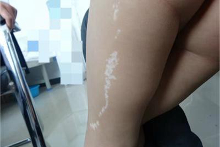 线状苔藓大腿白斑图 线状苔藓大腿白斑图