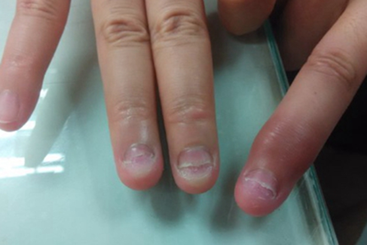 银屑病关节炎缺损图