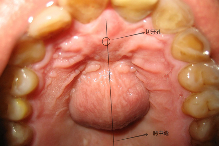 上颚正中囊肿位置图