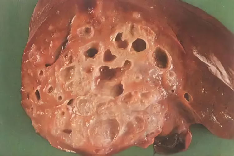 肝囊型棘球蚴病图