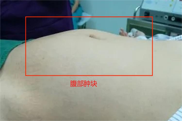 回盲部恶性肿瘤腹部肿块图