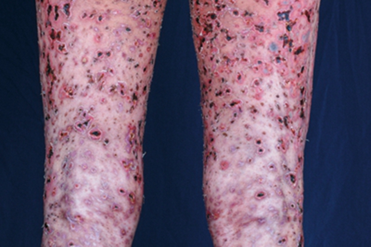 发热溃疡坏死性苔藓样糠疹黑痂图 发热溃疡坏死性苔藓样糠疹黑痂图