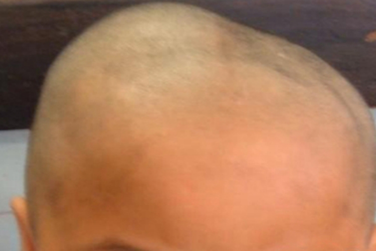 骨膜下血肿头顶长大包图 骨膜下血肿头顶长大包图