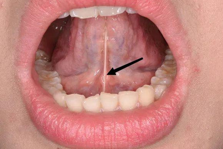 正常舌系带图 正常舌系带图