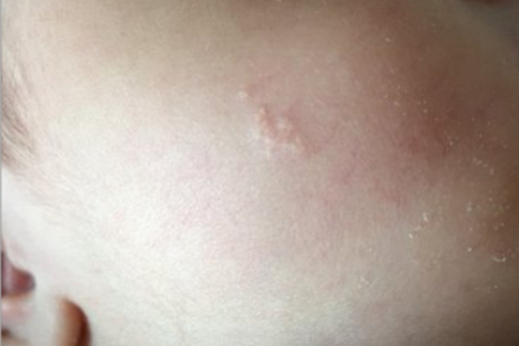 皮脂腺痣面部小疙瘩图