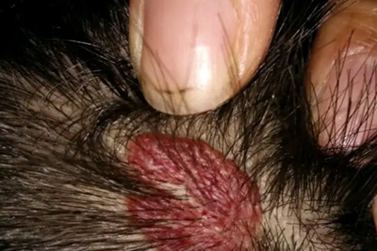 特发性头颈部血管肉瘤头皮红斑图