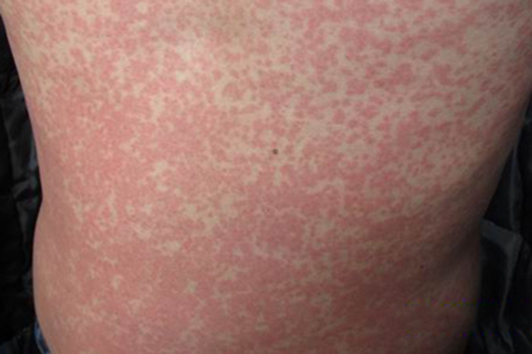播散性粟粒性皮肤结核背部症状图 播散性粟粒性皮肤结核背部症状图