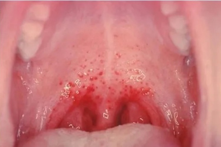 急性咽炎红斑图