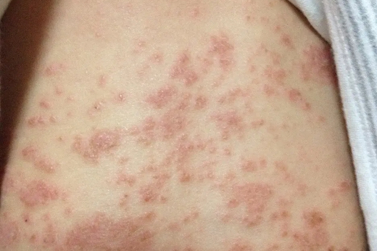 背部急性湿疹图 背部急性湿疹图