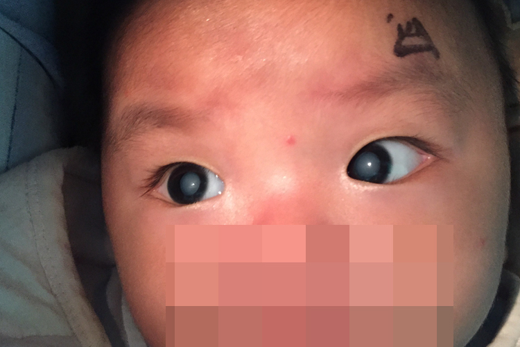 先天性白内障眼底白点图